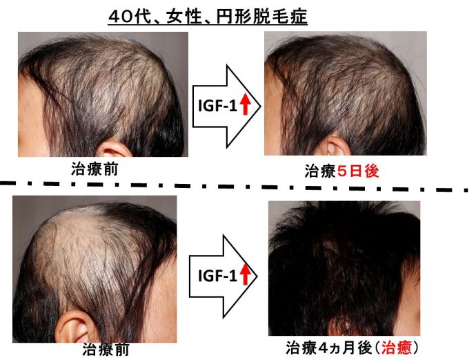 円形脱毛症　病院